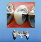 銀歯（パラジウム合金）
