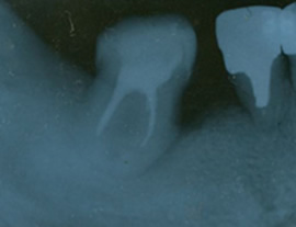 歯牙再植•移植